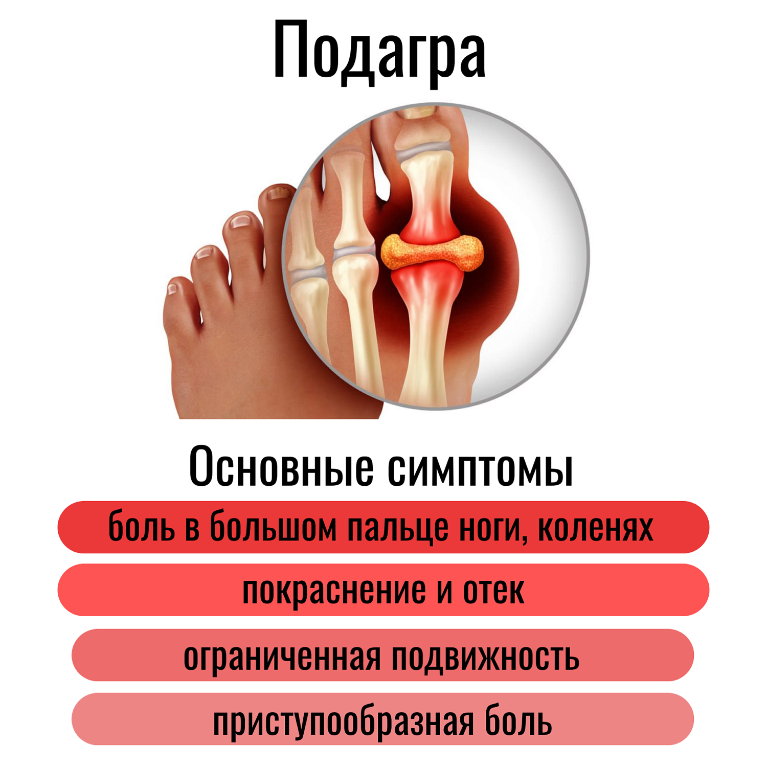 Подагра: что это за заболевание, как его распознать и какие ортопедические приспособления помогут облегчить симптомы  